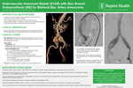 Endovascular Aneurysm Repair (EVAR) with Iliac Branch Endoprosthesis (IBE) for Bilateral Iliac Artery Aneurysms by Daniela Garcia, Ronald Mora Arria, Anand Tarpara, and Brian Schiro